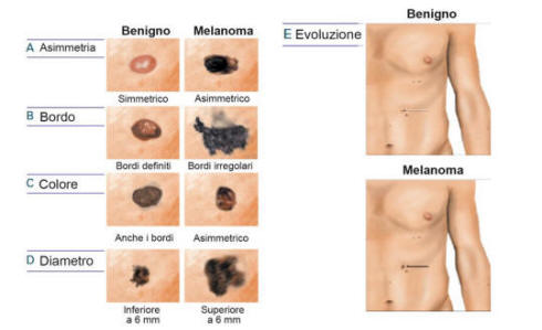 Melanoma | Skin Cancer | MedlinePlus